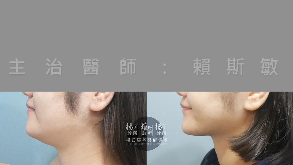 下巴抽脂 抽脂 雕塑