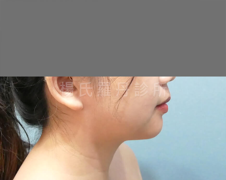下巴抽脂 雙下巴