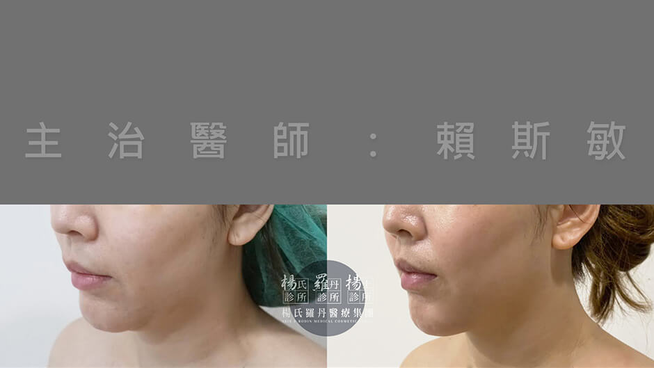 下巴抽脂 減脂