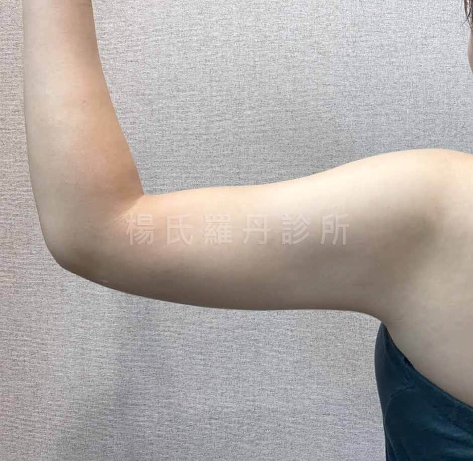 手臂抽脂 抽脂