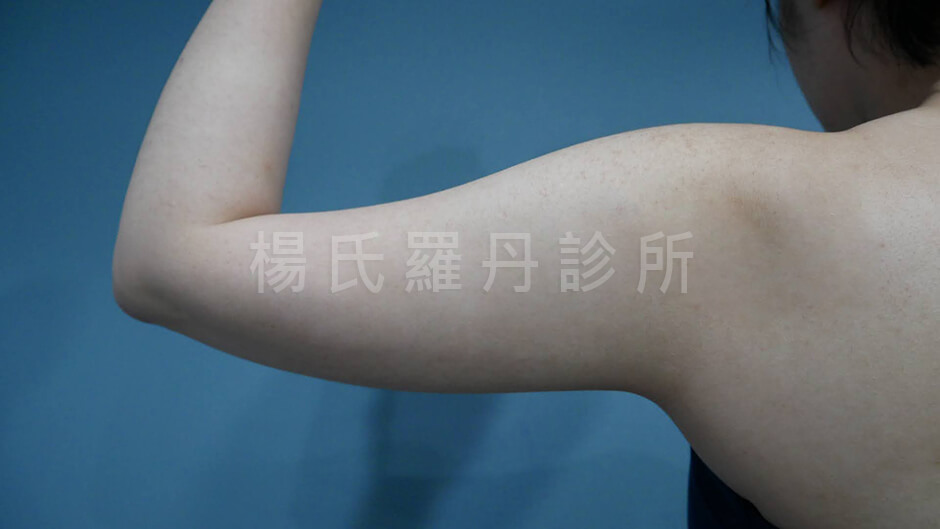 手臂抽脂 抽脂