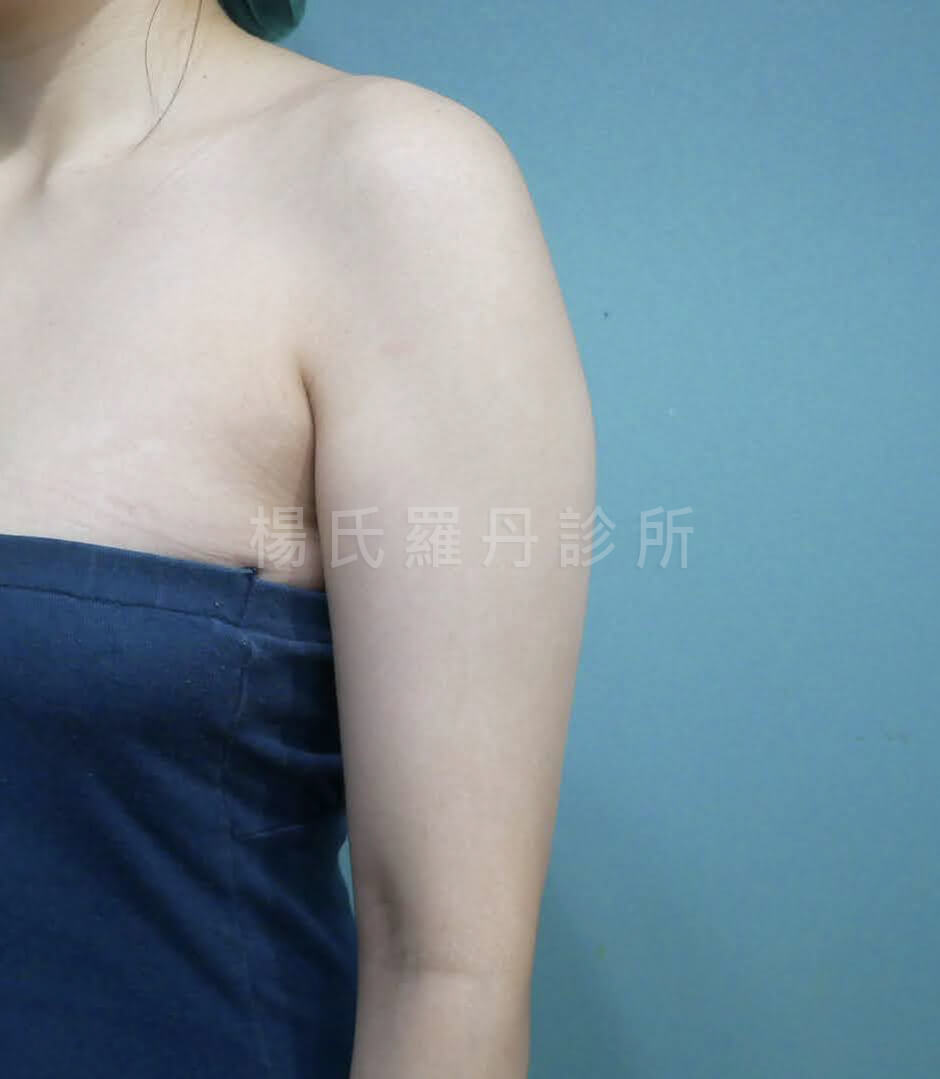 手臂抽脂 抽脂