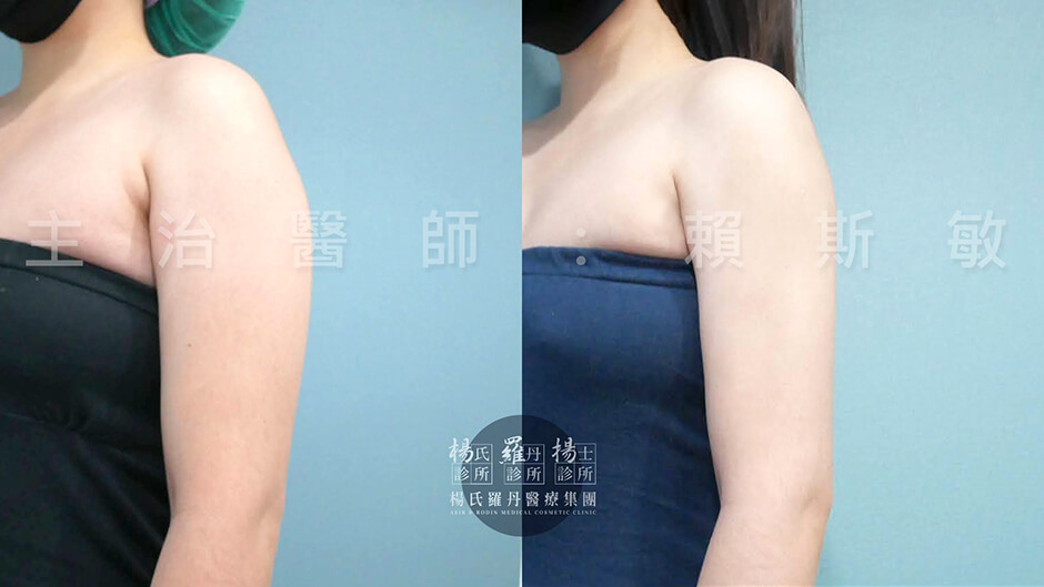 手臂抽脂 雷射減脂 減脂手術