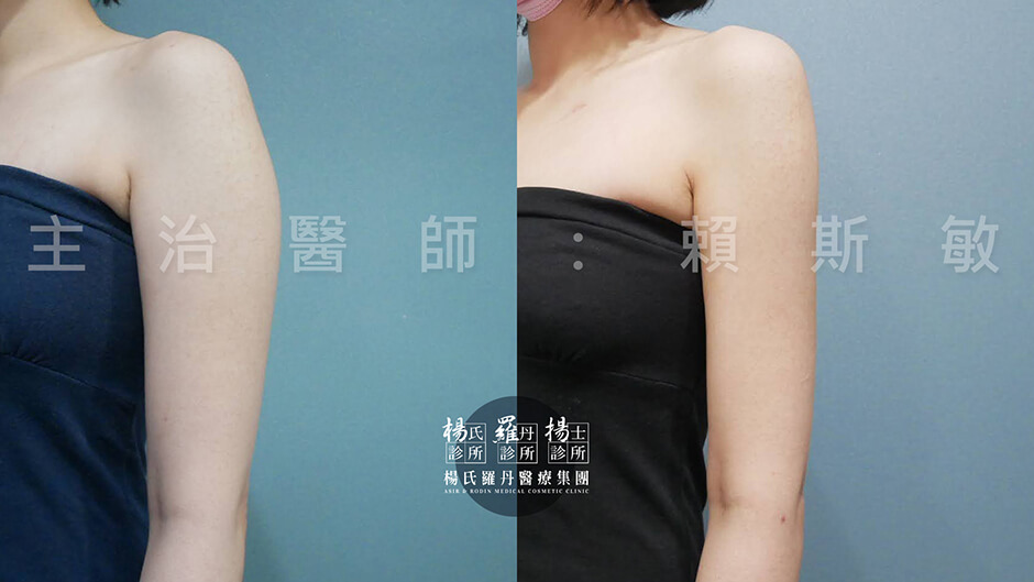 手臂抽脂 抽脂 雷射減脂