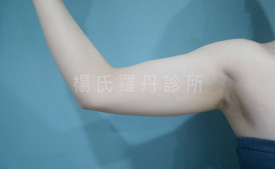 手臂抽脂 瘦手臂