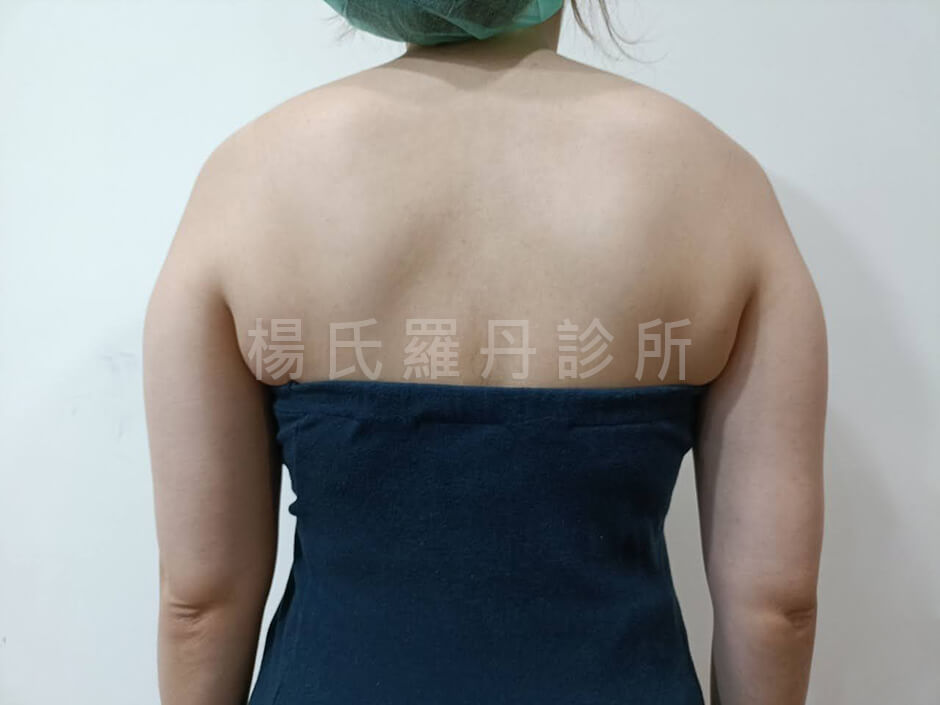 手臂抽脂 雷射減脂