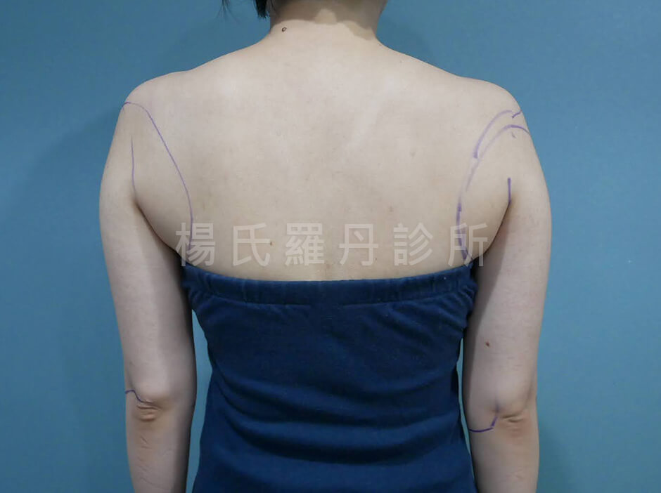 手臂抽脂 瘦手臂