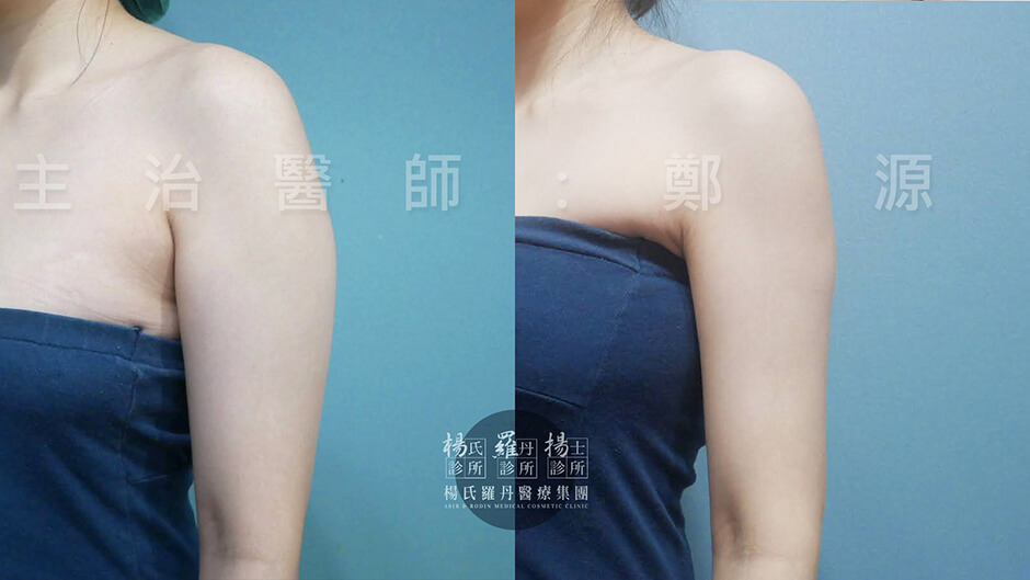 手臂抽脂 抽脂 雷射減脂