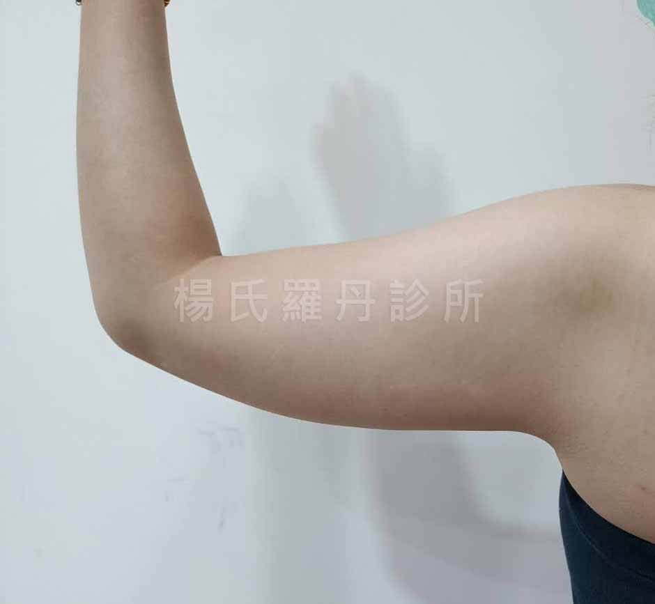 手臂抽脂 蝴蝶袖