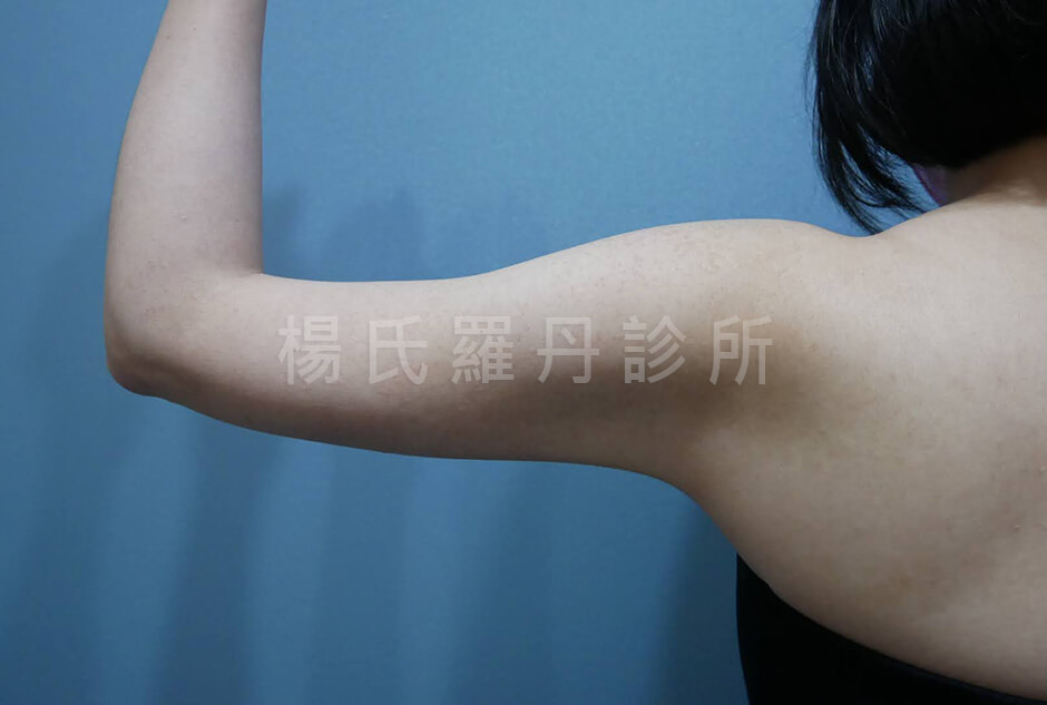 手臂抽脂 雷射減脂