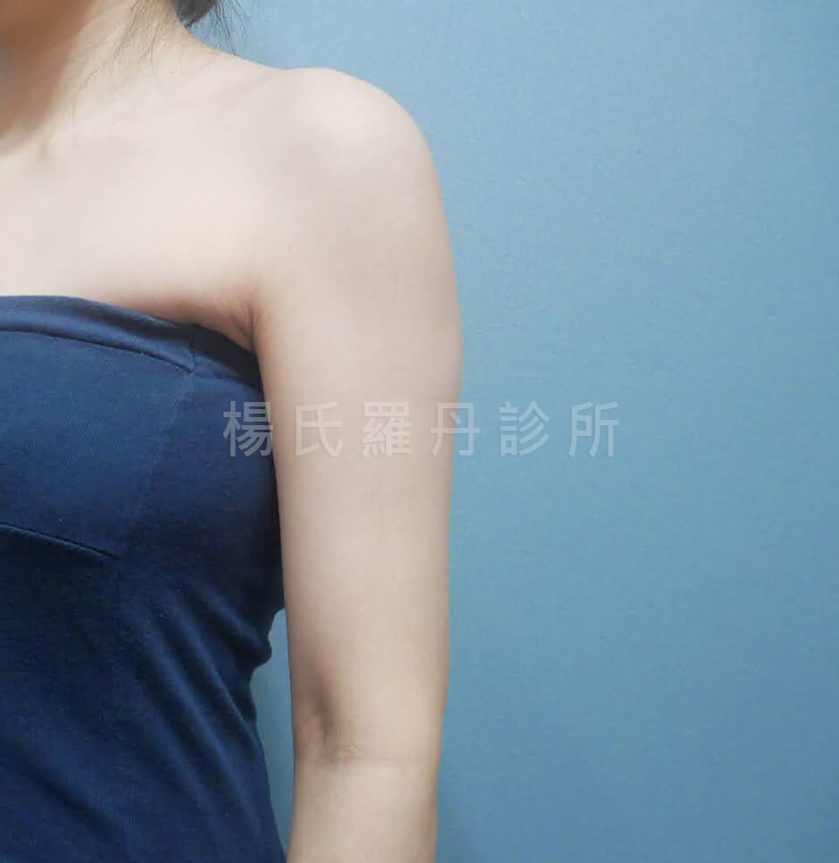 手臂抽脂 雷射減脂