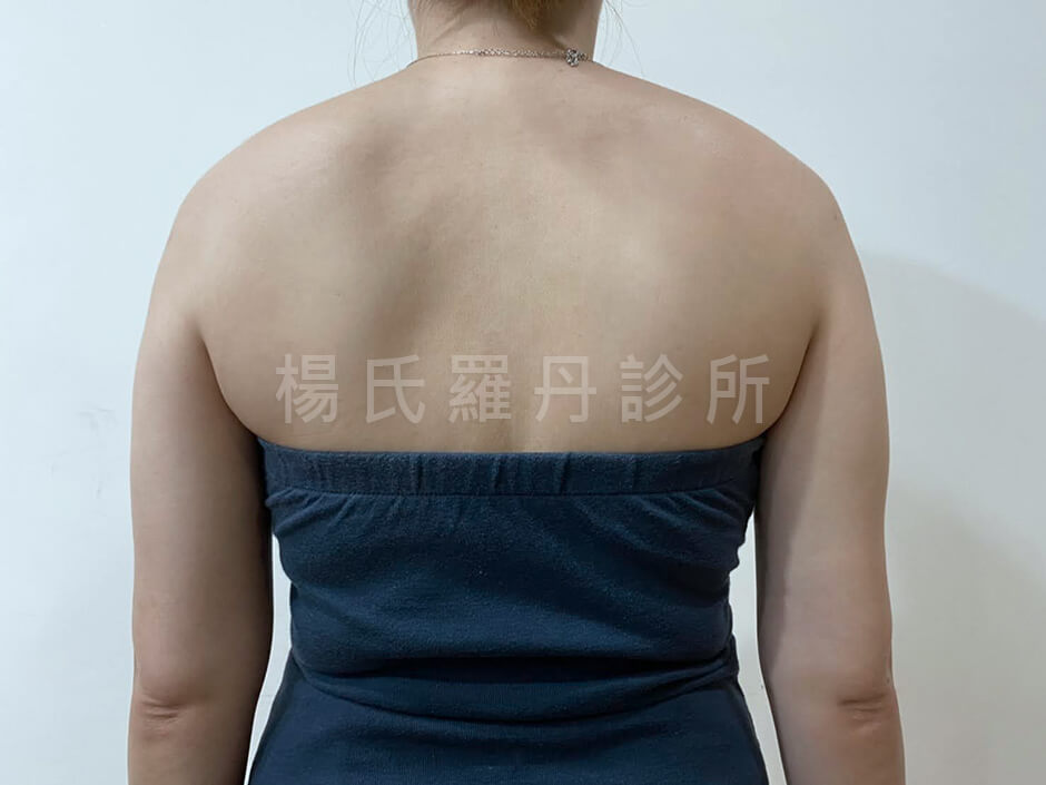 手臂抽脂 瘦手臂