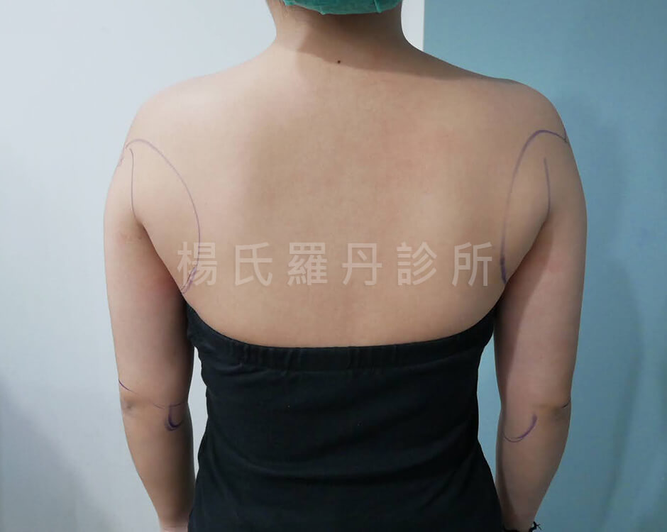 手臂抽脂 雷射減脂