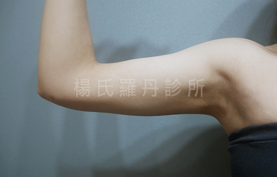 雷射減脂 減脂