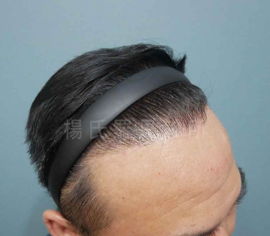 植髮 髮際線 植髮手術