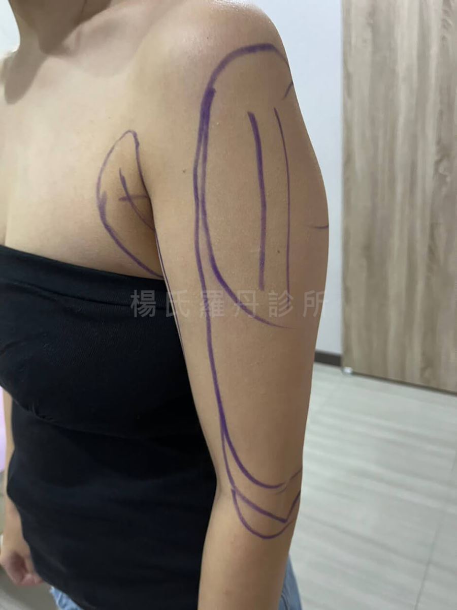 手臂抽脂 抽脂