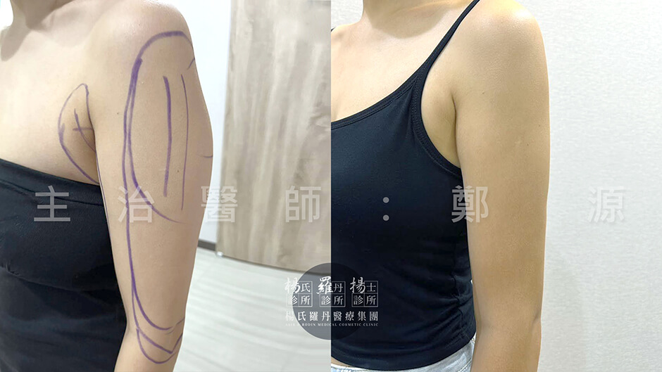 抽脂 手臂抽脂 雷射減脂