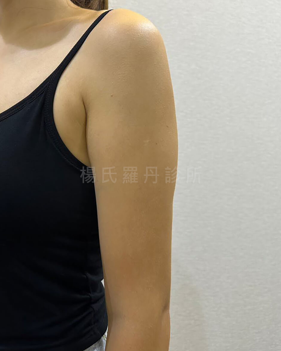 手臂抽脂 瘦手臂