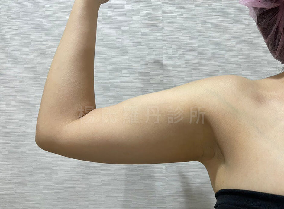 手臂抽脂 雷射減脂