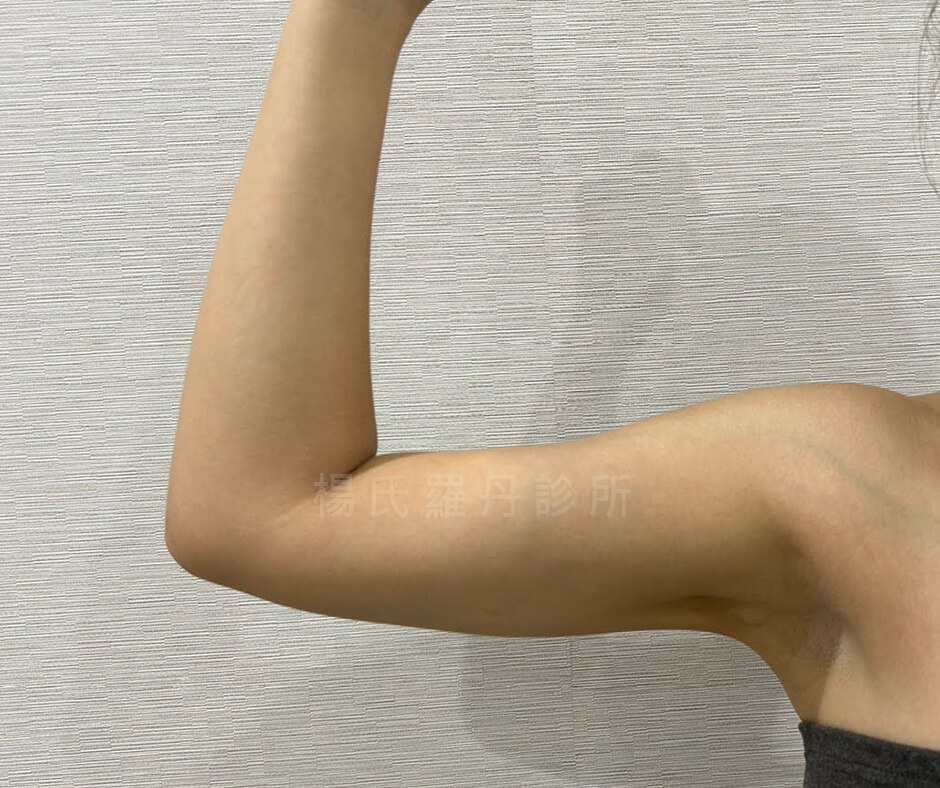 手臂抽脂 減脂 減脂手術