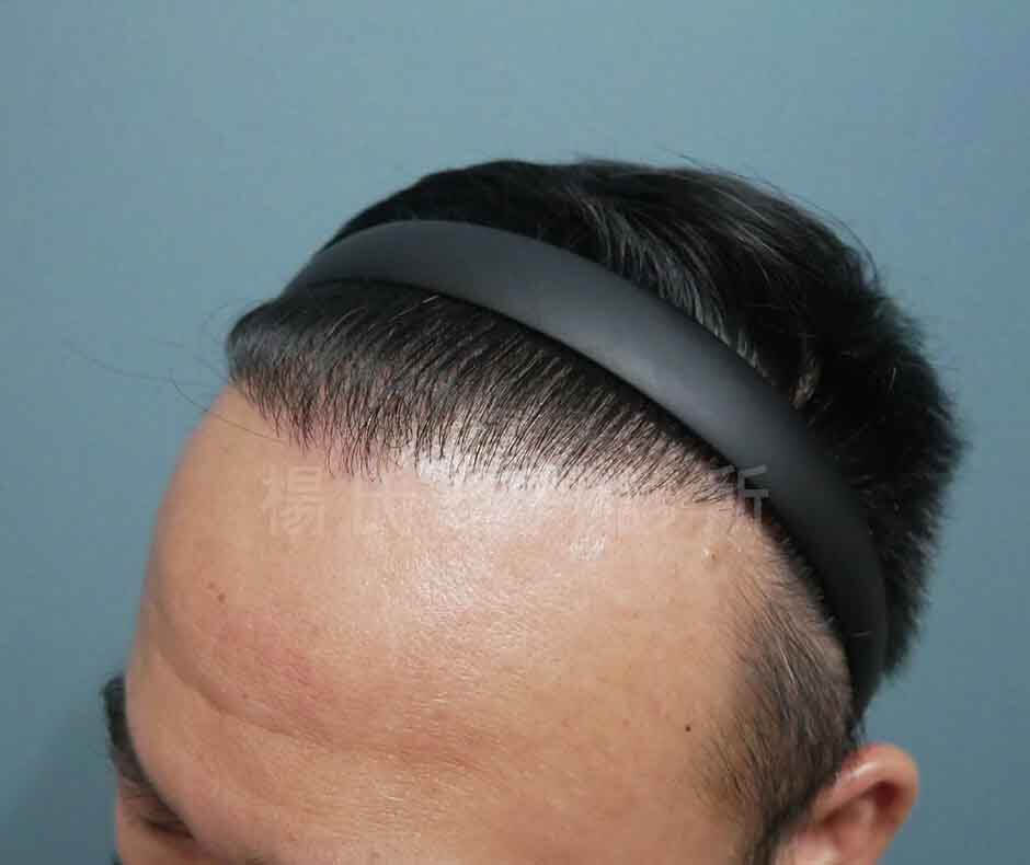 植髮 植髮效果