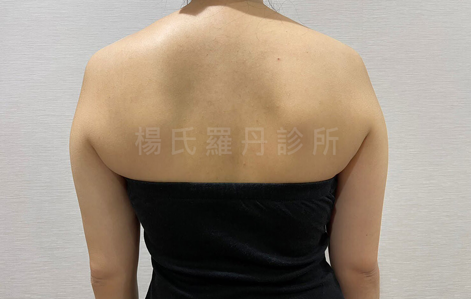 雷射減脂 雕塑