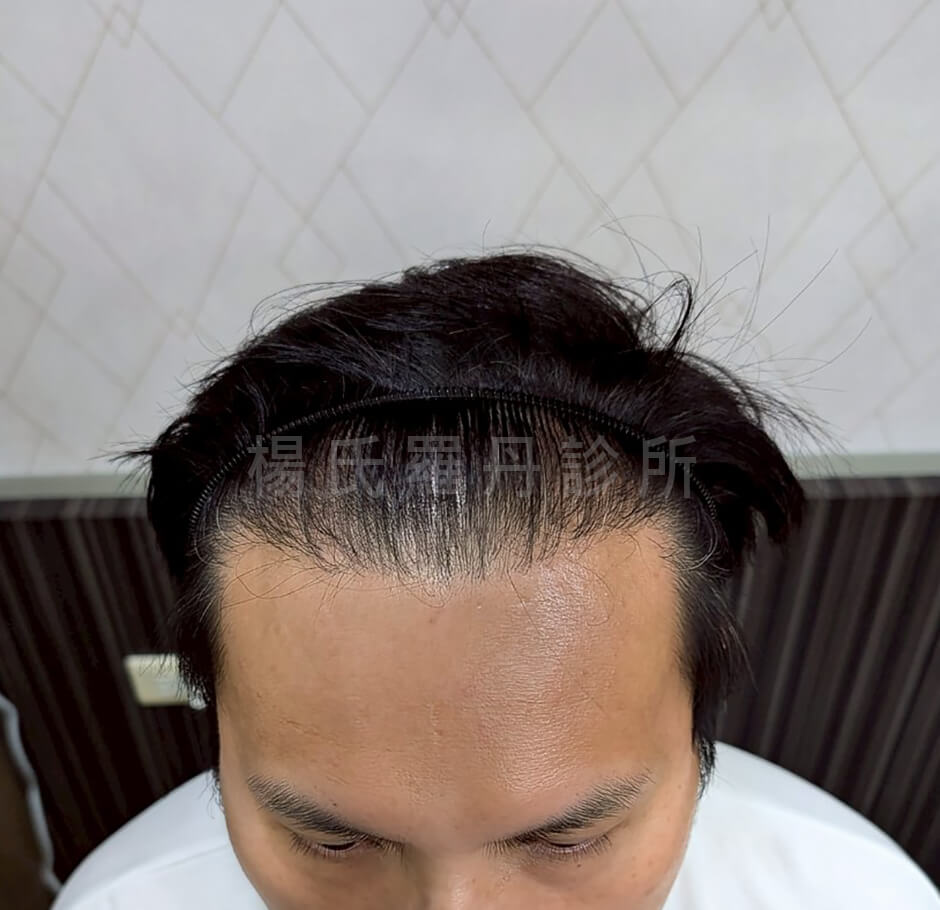 植髮 落髮 