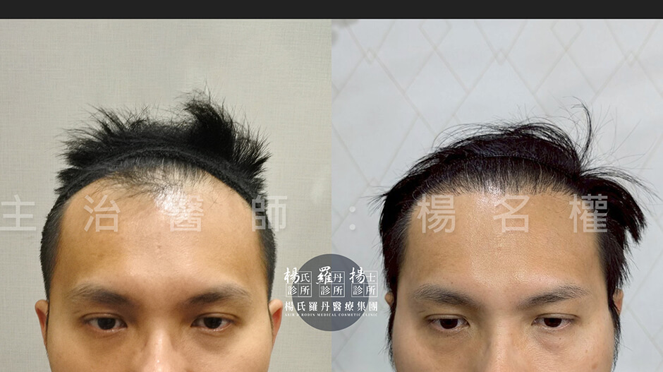 植髮 植髮成果 植髮手術