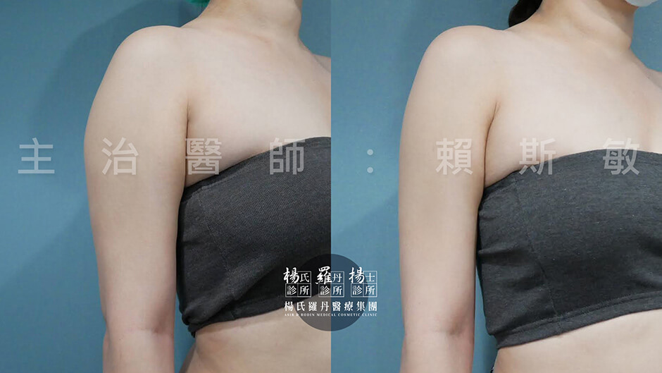 減脂 減脂手術 雷射減脂