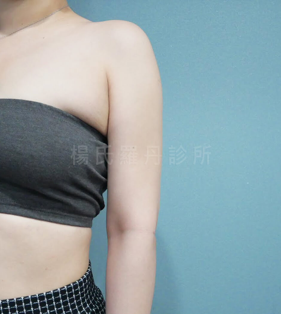 手臂抽脂 瘦手臂