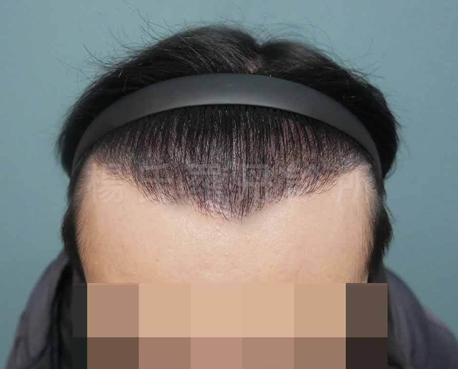 植髮 髮際線