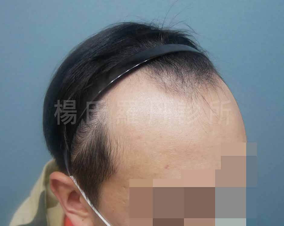 植髮 掉髮