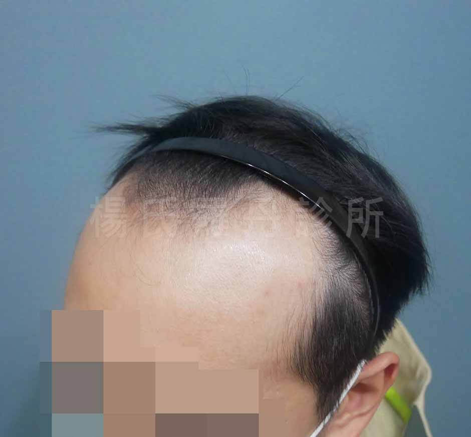 植髮 髮際線植髮
