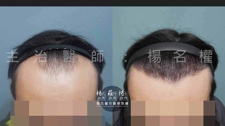 植髮 禿髮 植髮效果