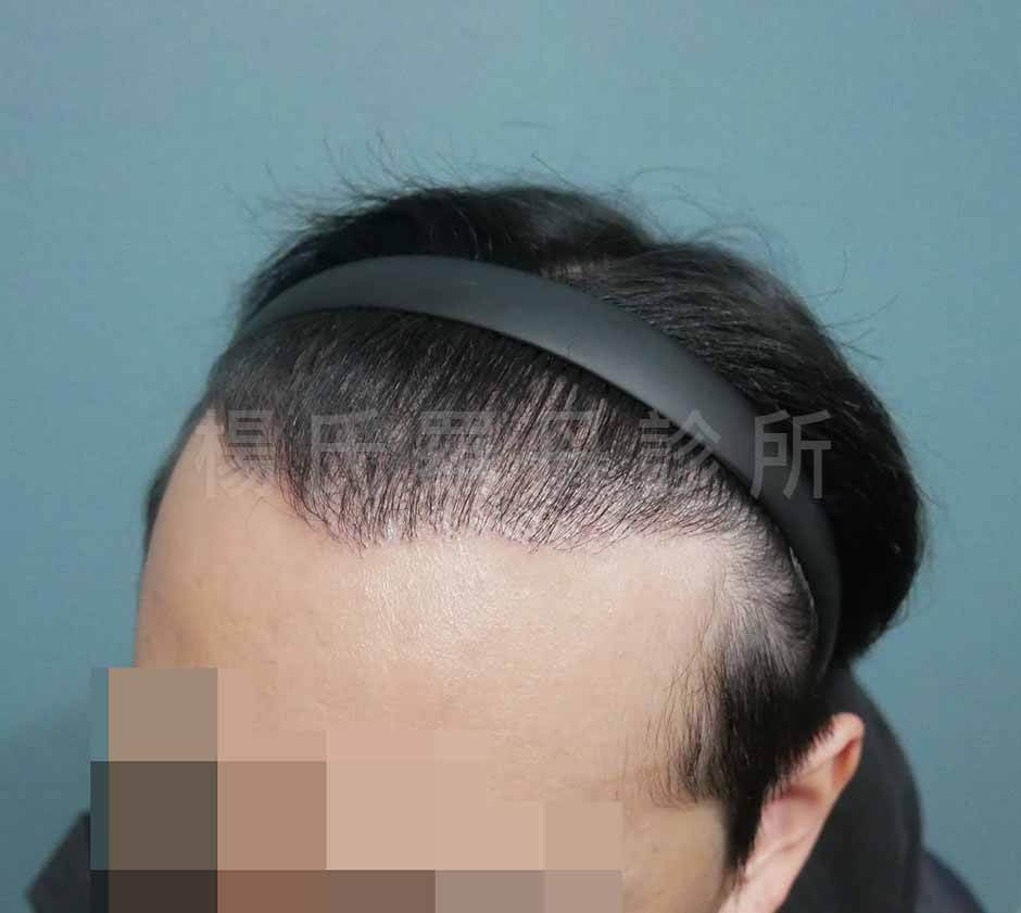 植髮效果 植髮