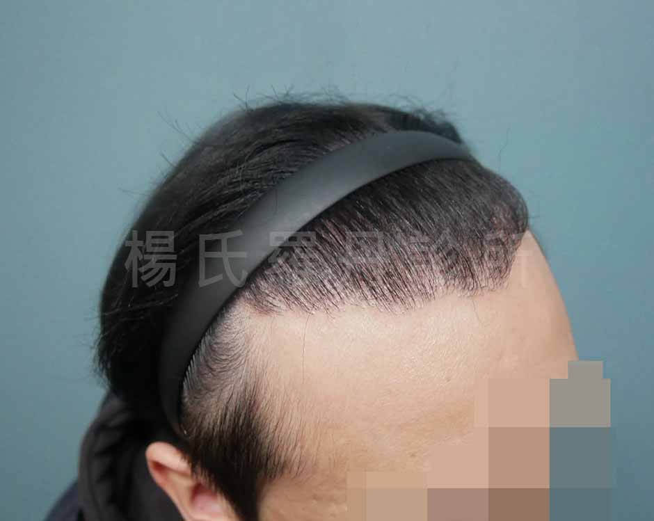 植髮 植髮效果