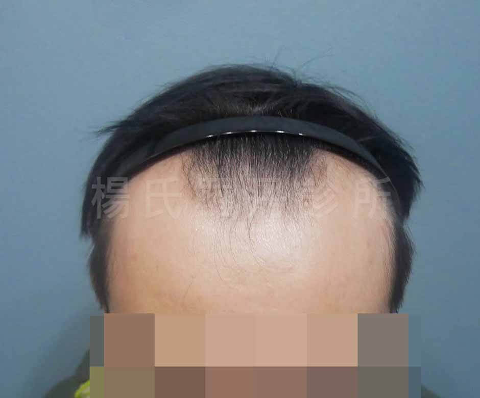 植髮 禿髮
