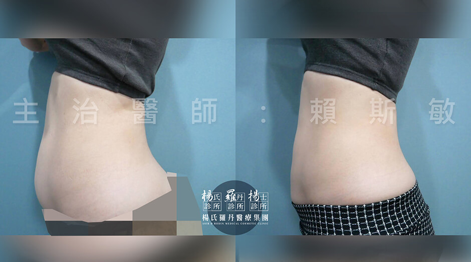 腹部抽脂 雷射減脂