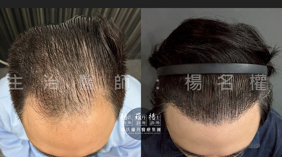 植髮 微創植髮 植髮成果