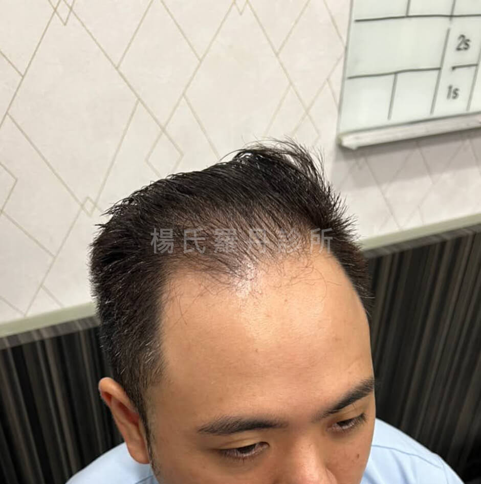 植髮成果 植髮