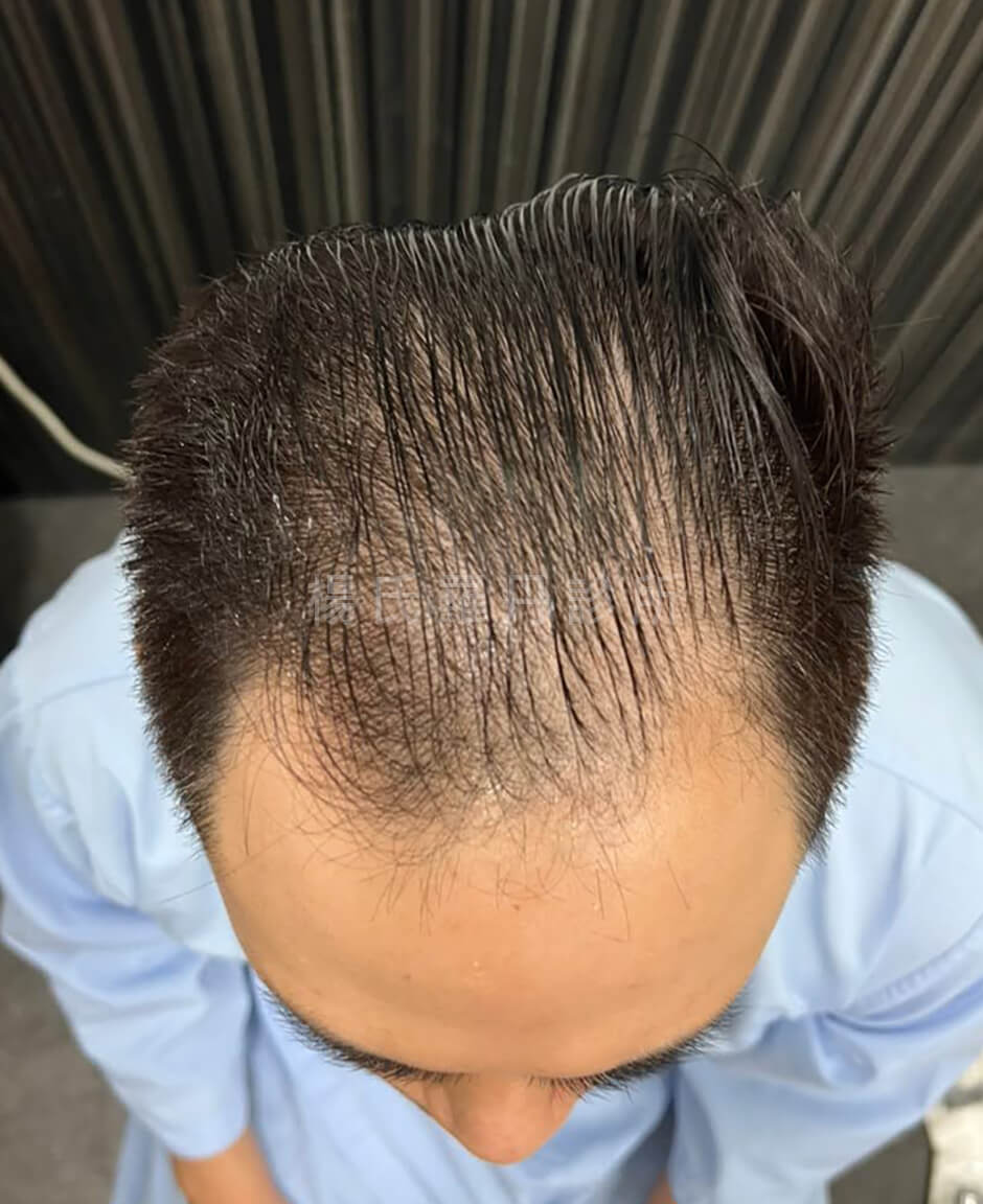 植髮 禿髮