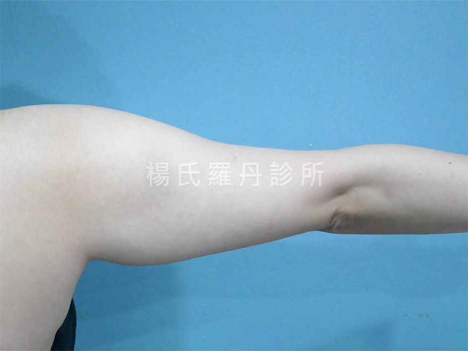 手臂抽脂 瘦手臂