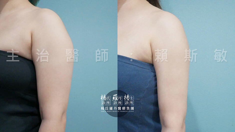 手臂抽脂 雷射減脂 抽脂