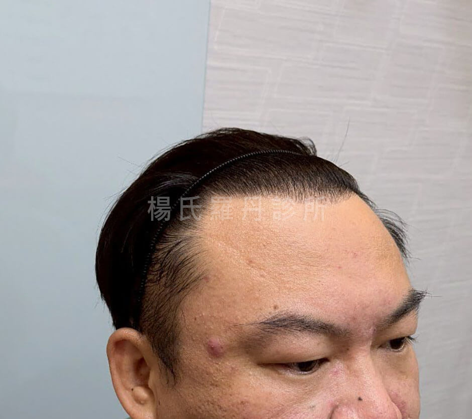 植髮 微創植髮