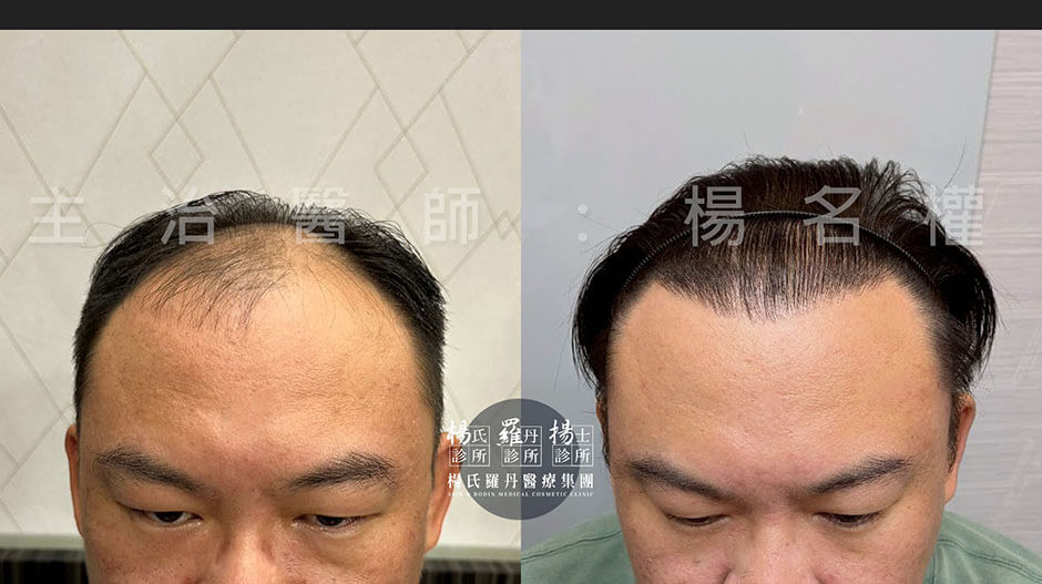 植髮 微創植髮 植髮效果