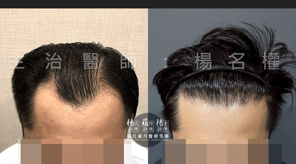 植髮 植髮效果 植髮手術
