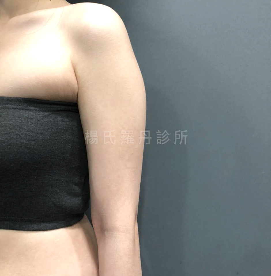 手臂抽脂 抽脂