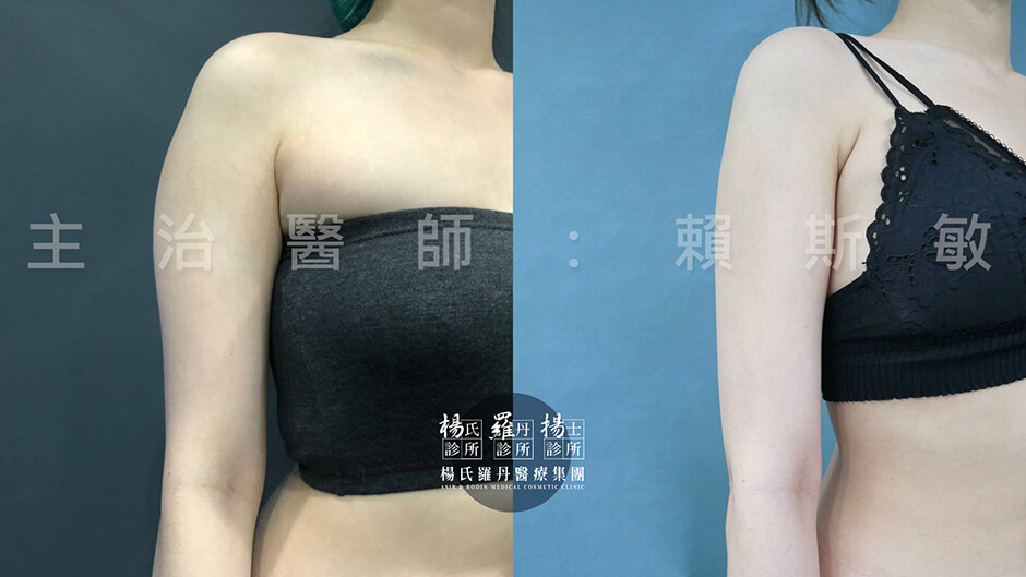 手臂抽脂 雷射減脂 抽脂