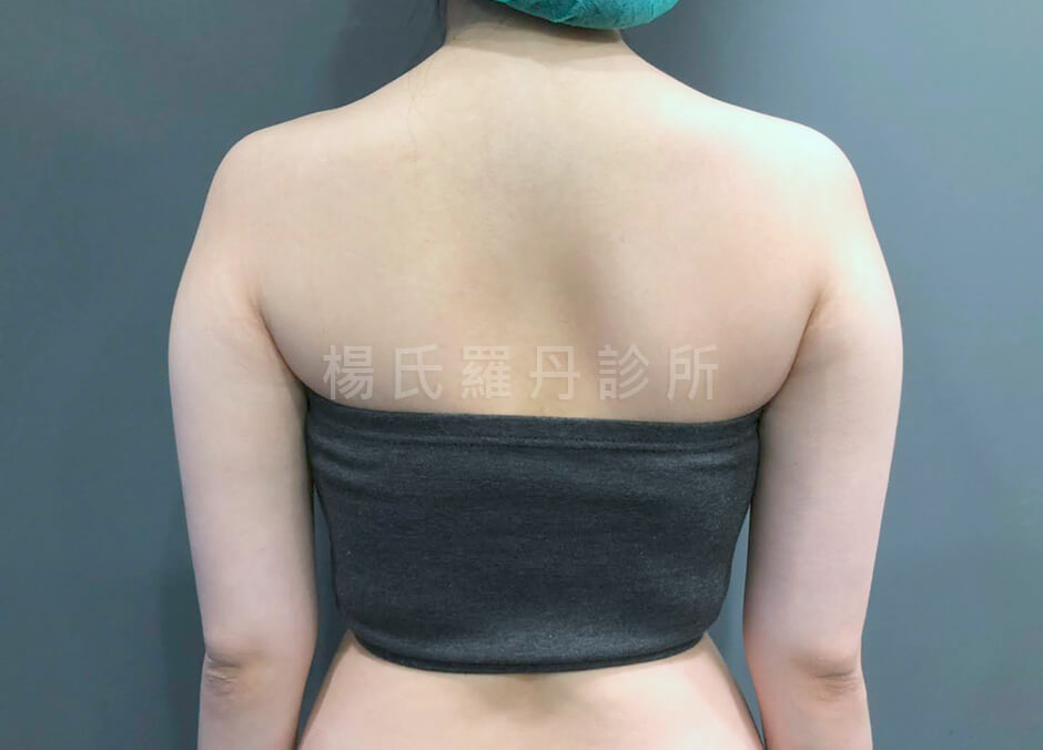 手臂抽脂 瘦手臂