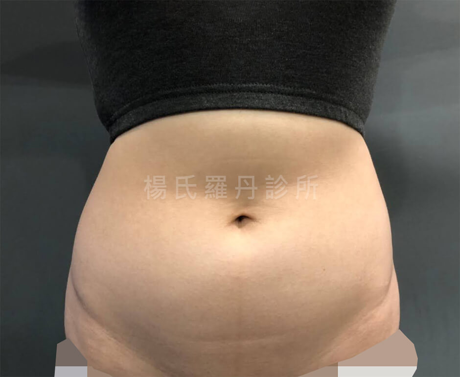 腹部抽脂 抽脂
